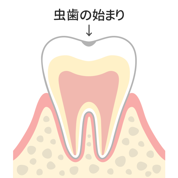 ごく初期のむし歯