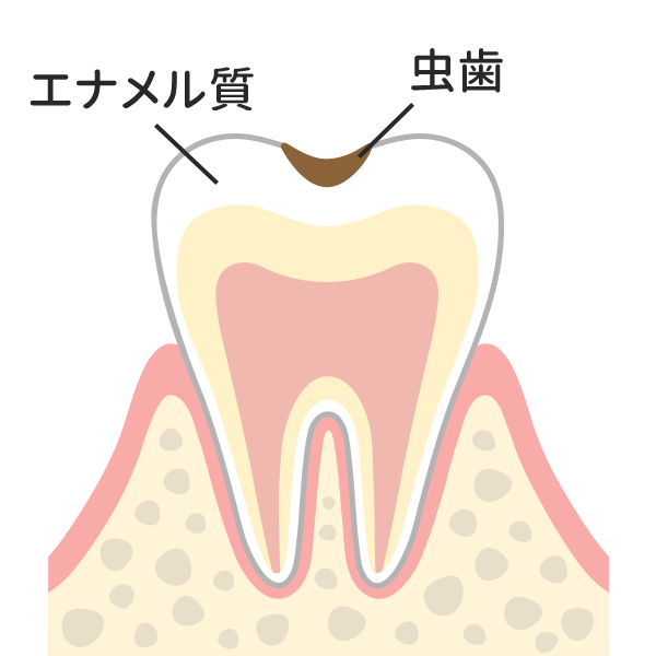 エナメル質に小さな穴が空いたむし歯