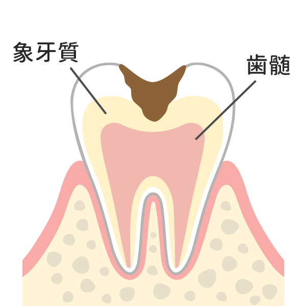 歯の内部（象牙質）まで進行したむし歯