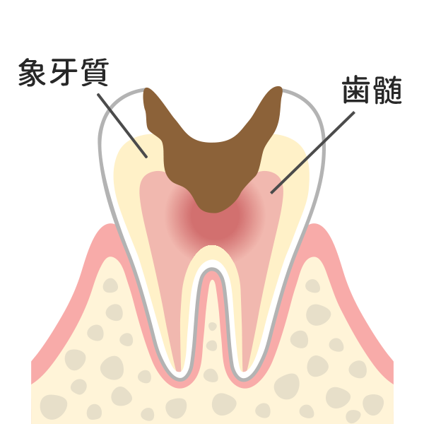 神経まで進行したむし歯
