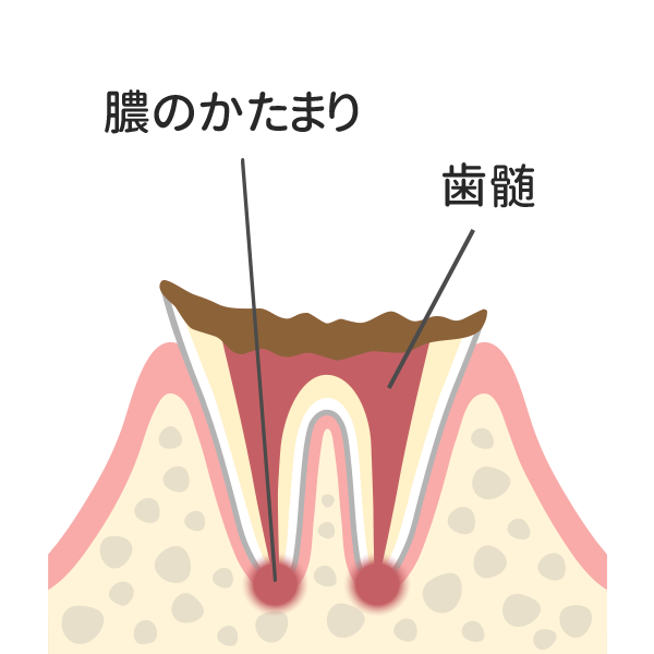 歯根まで進行したむし歯