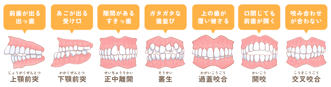 不正咬合