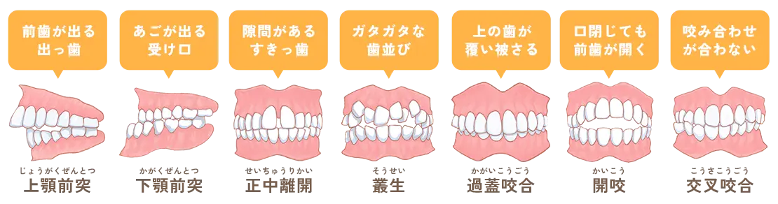不正咬合