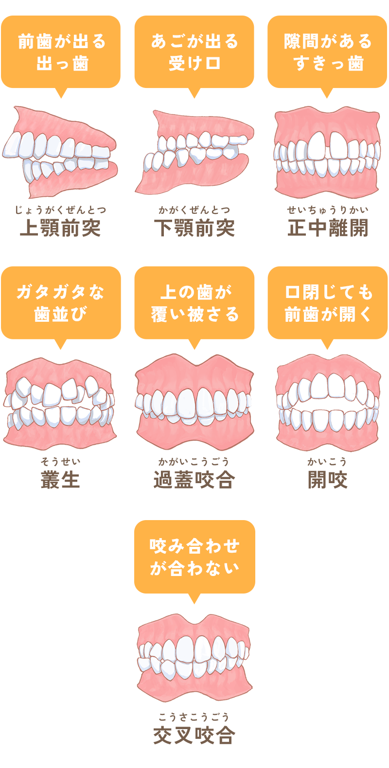 不正咬合