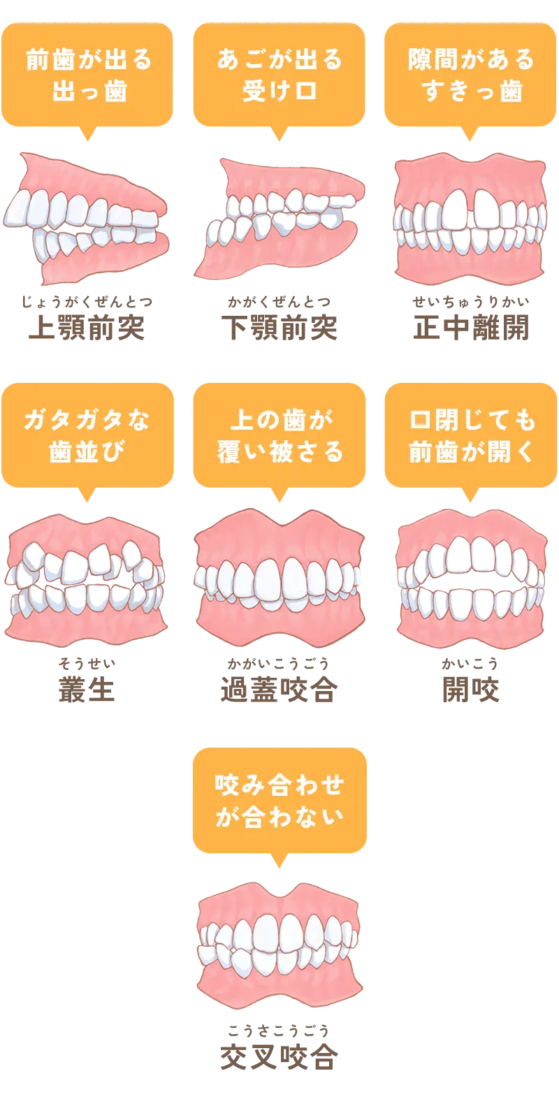 不正咬合
