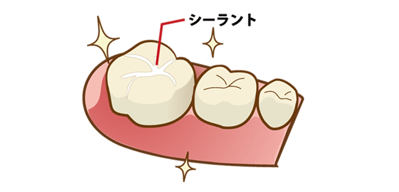 シーラント