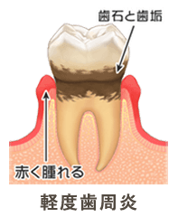 軽度歯周病
