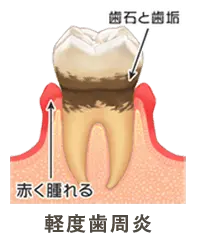 軽度歯周病