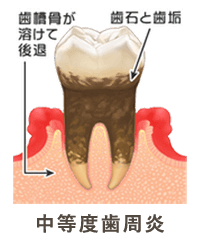 中度歯周病