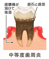 中度歯周病