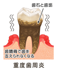 重度歯周病