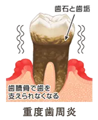 重度歯周病