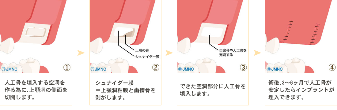 サイナスリフト法