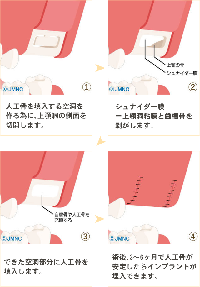サイナスリフト法