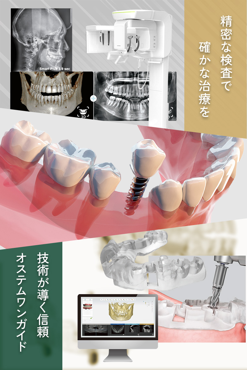インプラント 骨造成