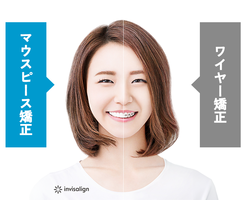 矯正治療の比較
