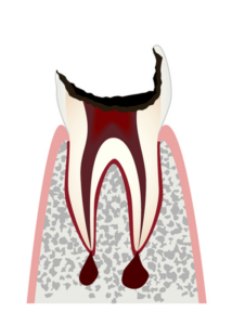 C4歯根まで進行したむし歯